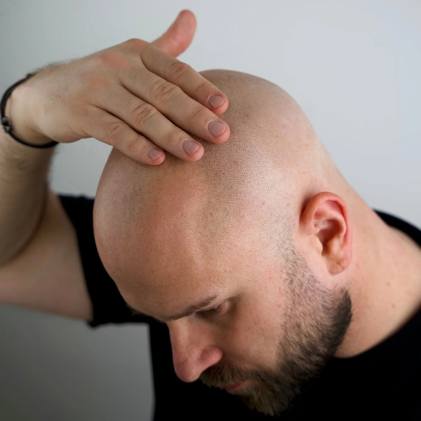 Solid Bald Head Peeling